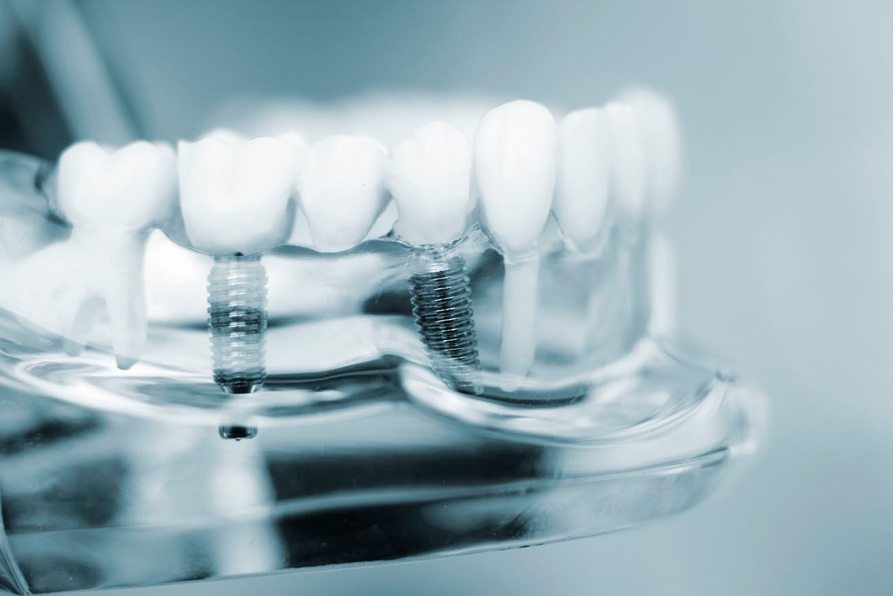 Dentures or Dental Implants? Dental Implants Indianapolis, IN