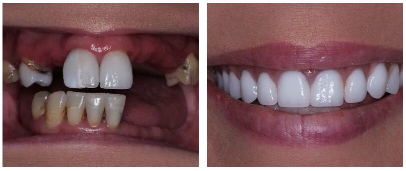 Dental patient before and after implant supported dentures