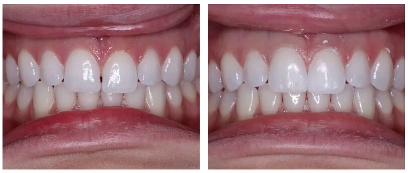 Happy patient before and after dental bonding at North Meridian Dental Excellence