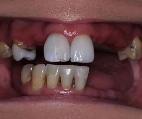dentures-1-before-500×420 dentures-1-before-500x420